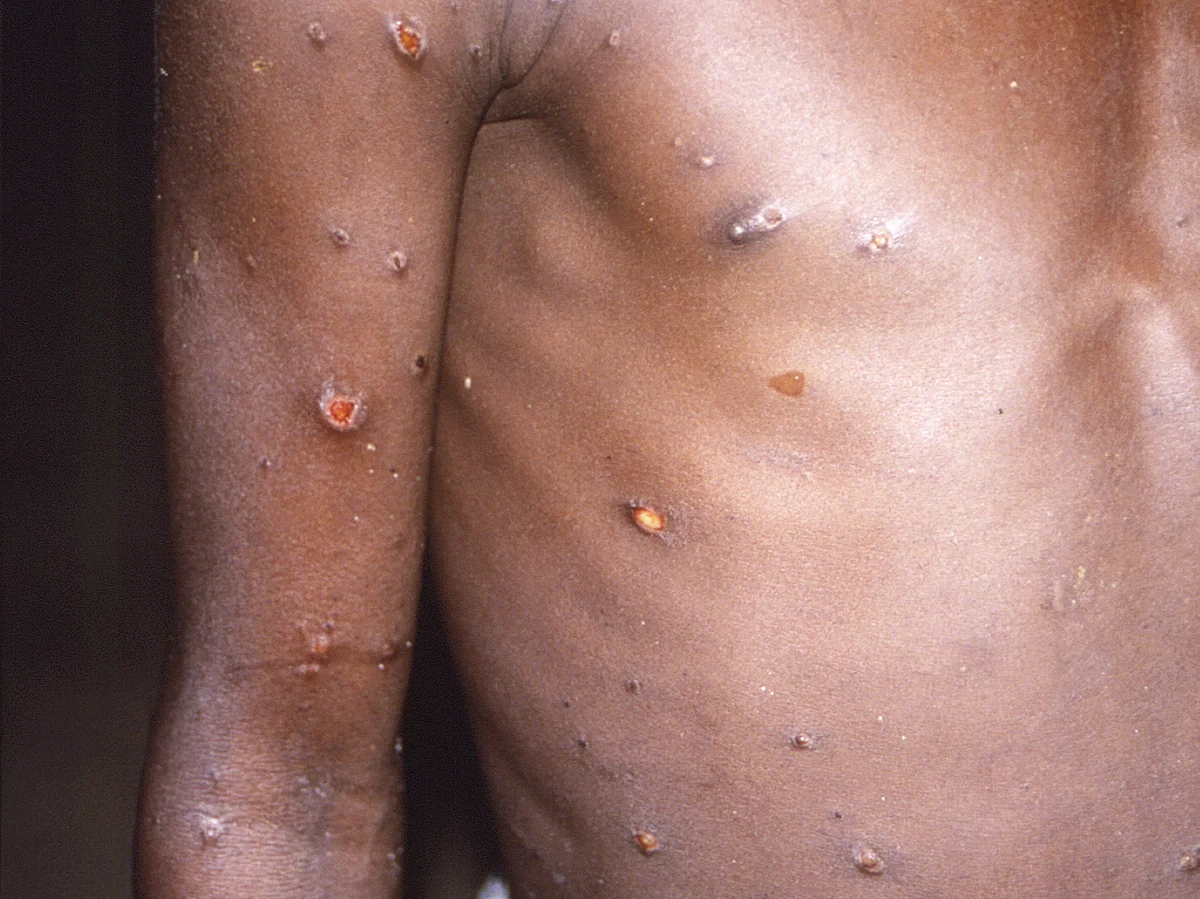 [A 1997 image provided by CDC of a patient with monkeypox lesions. The World Health Organization declared the virus a public health emergency of global concern Saturday.]